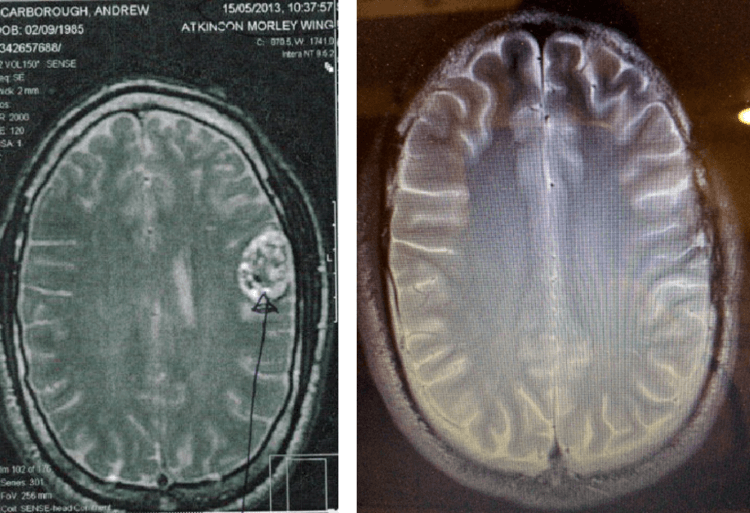 Andrew's brain tumor before and after being on the ketogenic diet.